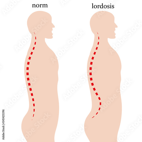 Schematic representation of lordosis, curvature of the spine. Vector illustration