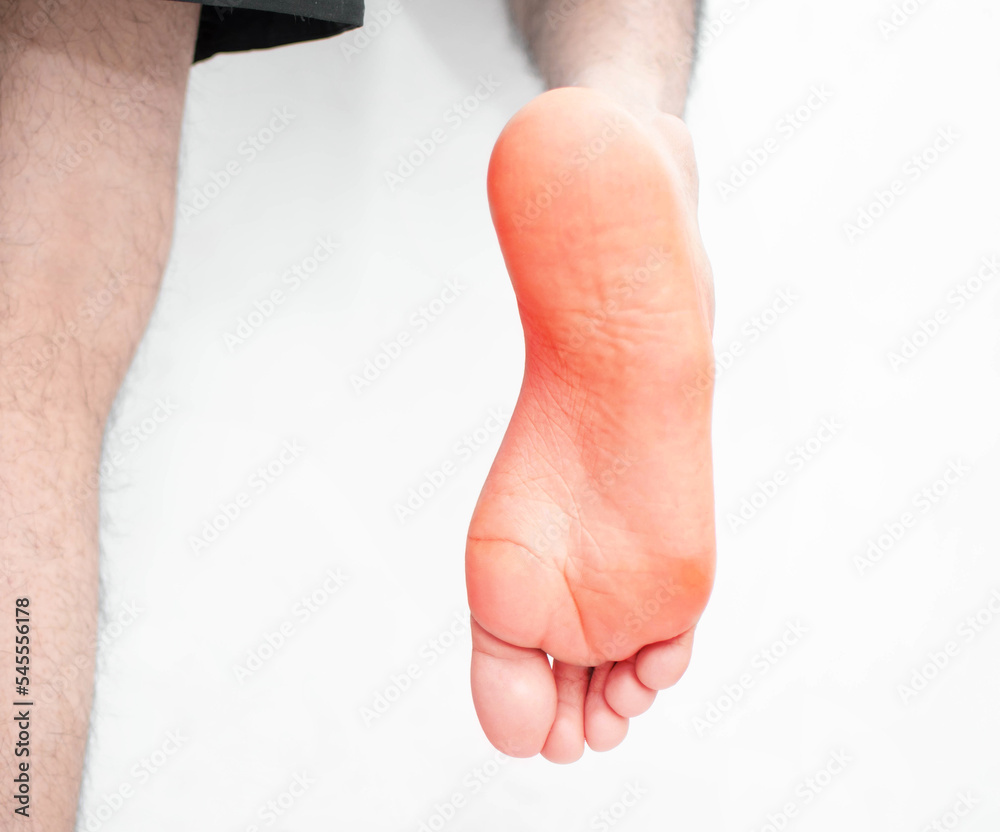 Pie con enrojecimiento y hormigueo lastimado herido de un joven hombre