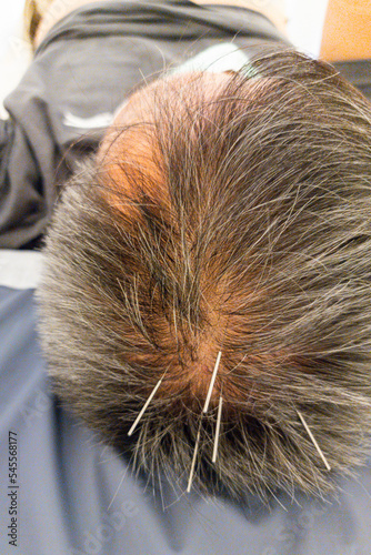 Asian man receiving acupuncture treatment on head