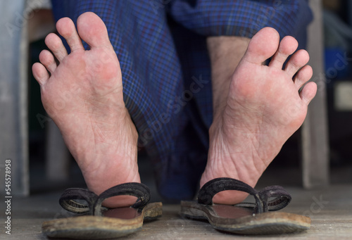 Foot of Asian man. Concept of foot care, pain and health. photo