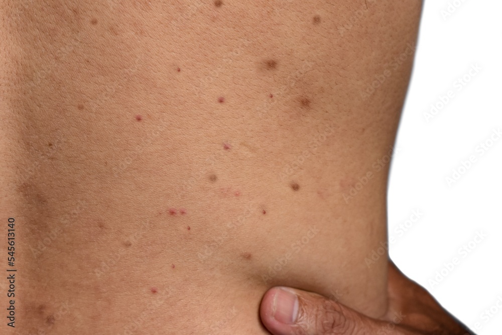 Black spots, pimples, acne and scars on the back of Asian man Black spots, pimples, acne and scars on the back of Asian man