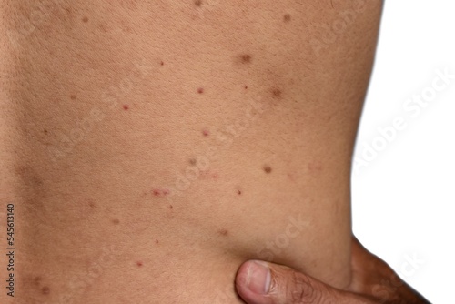 Black spots, pimples, acne and scars on the back of Asian man