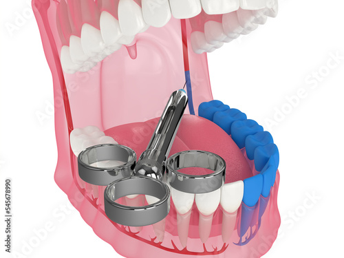 3d render of human jaw with inferior alveolar nerve block technique