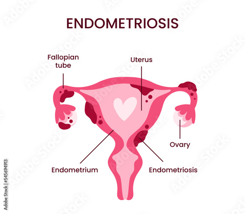 Anatomical illustration of the female reproductive system with the symptoms of endometriosis. Diseases of the female reproductive system. diagram with annotations.