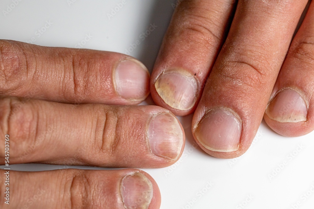 Nail psoriasis affects up to 60% of patients. Read our article 👉  https://loom.ly/cCJi1mI | PsOPsA Hub posted on the topic | LinkedIn
