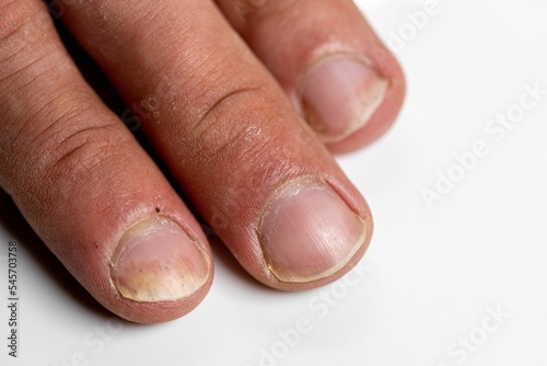 Closeup of the fingers of a patient with Psoriatic onychodystrophy or psoriatic nails disease photo