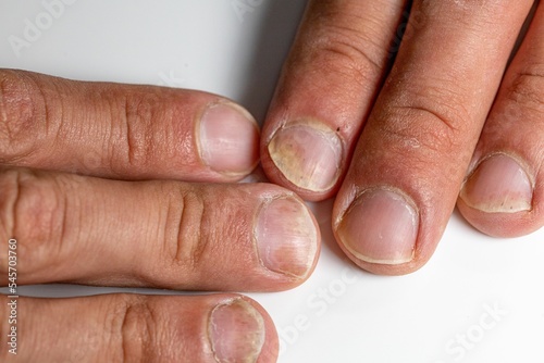 Closeup of the fingers of a patient with Psoriatic onychodystrophy or psoriatic nails disease photo