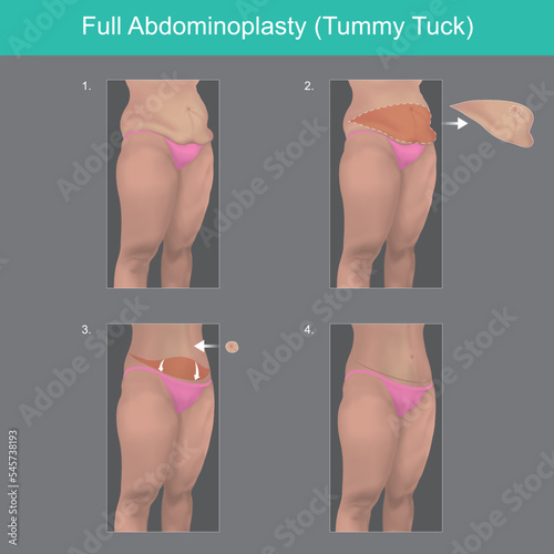 Full Abdominoplasty. Explain to understand on steps a surgery out of body belly fat..