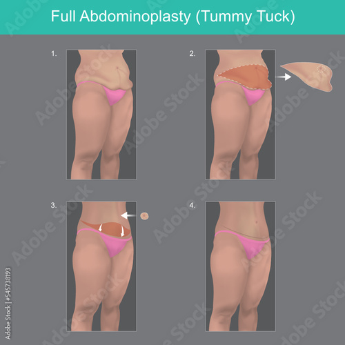 Full Abdominoplasty. Explain to understand on steps a surgery out of body belly fat.. photo