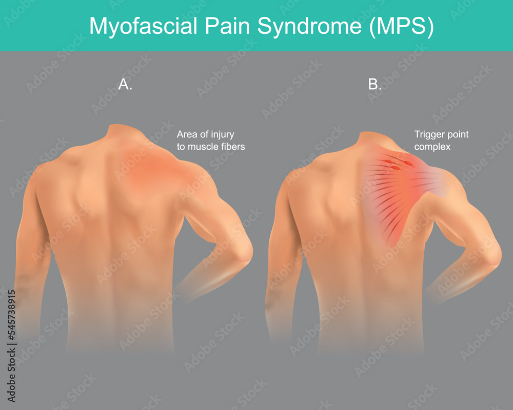 Trigger points Pain Syndrome. The back chronic pain disorder in a human