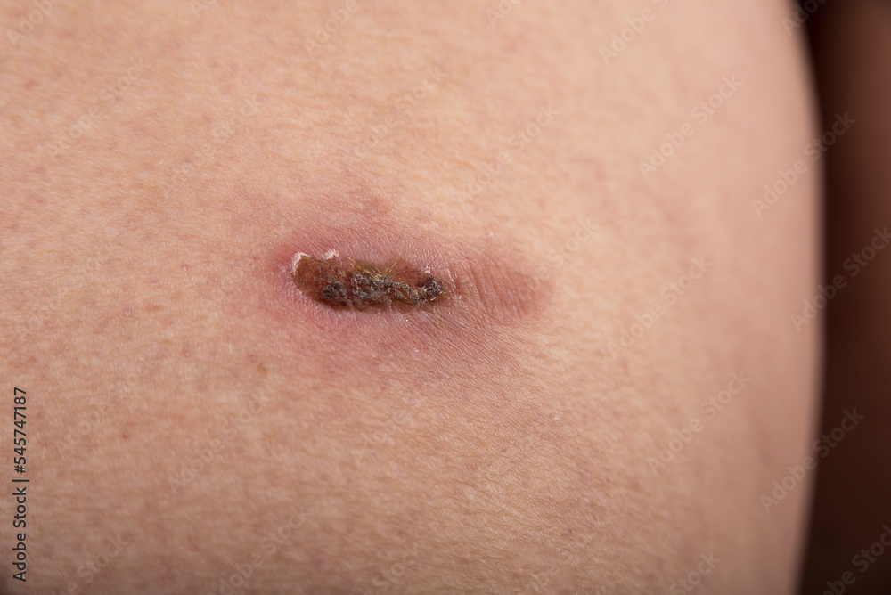 Dry up scratch scab on the woman tigh