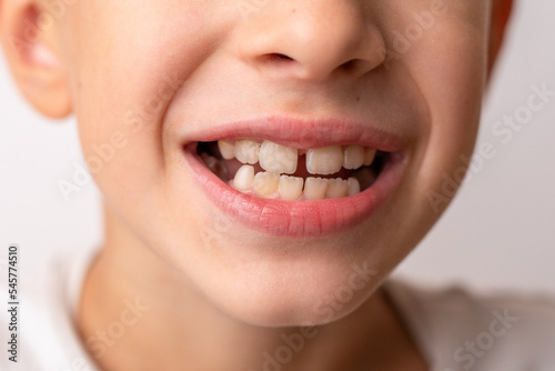 The child has a gap between the front teeth. The concept of orthodontic and stomatology