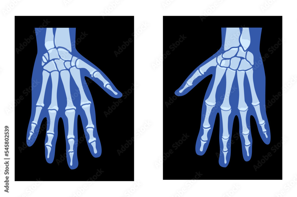 hand x ray clipart