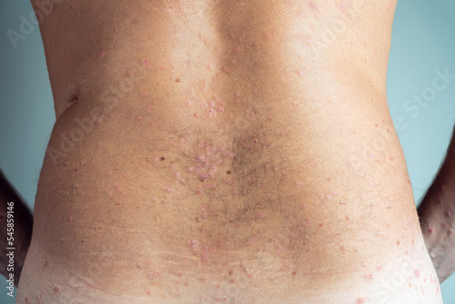 Billede på lærred Back view of bare back of unrecognizable man showing scaly flaky affected skin with blemishes suffering from psoriasis