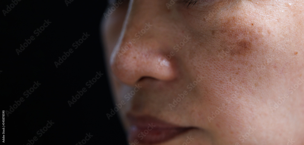 melasma on woman face. isolated  on dark background
