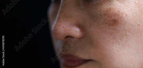 melasma on woman face. isolated  on dark background photo