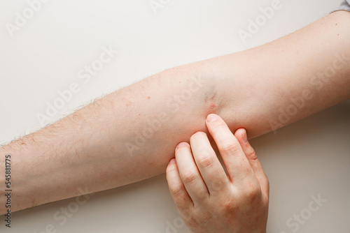 Forefinger points on vein injection mark on arm. Bruising, redness from syringe puncture. Patient or drug addict. Illness, drug addiction concept