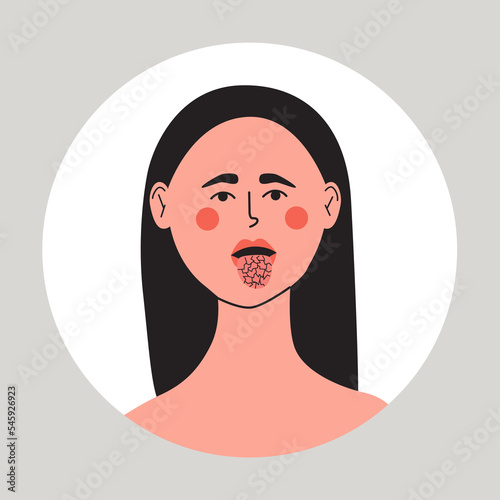 Young woman with dry mouth and tongue, xerostomia problem. Flat vector medical illustration