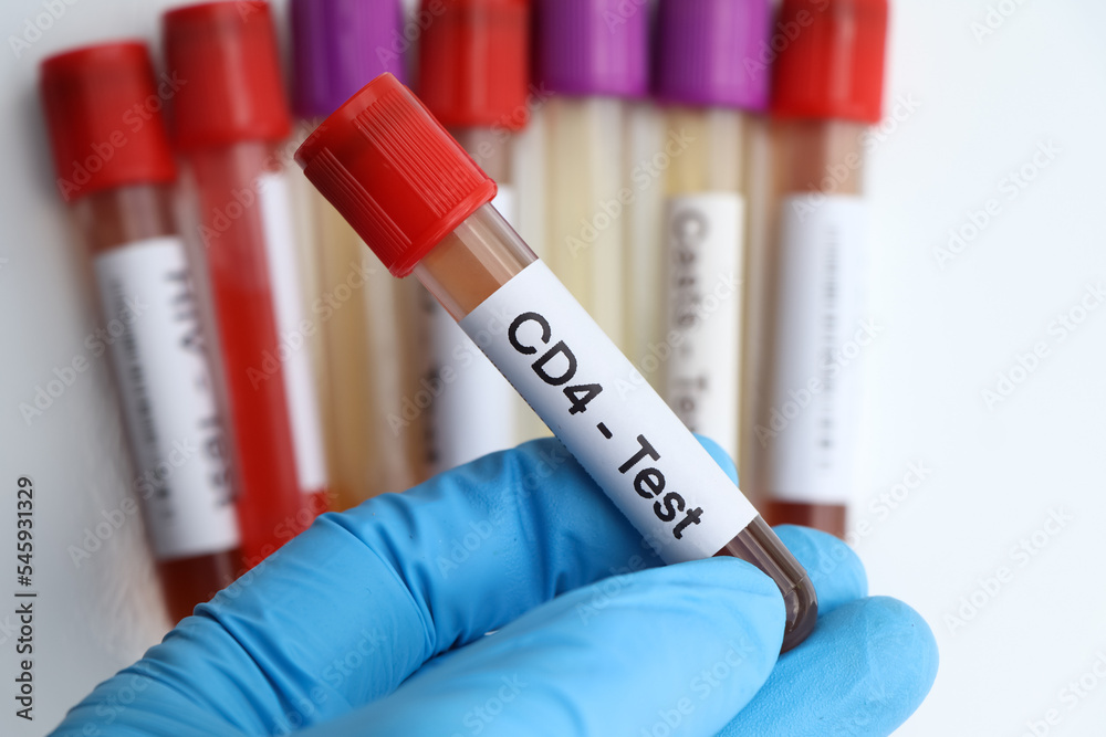 Fototapeta premium CD4 test to look for abnormalities from blood
