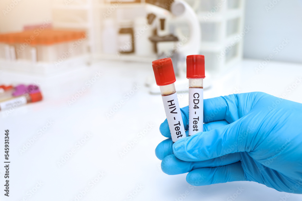 HIV test and CD4 test to look for abnormalities from blood
