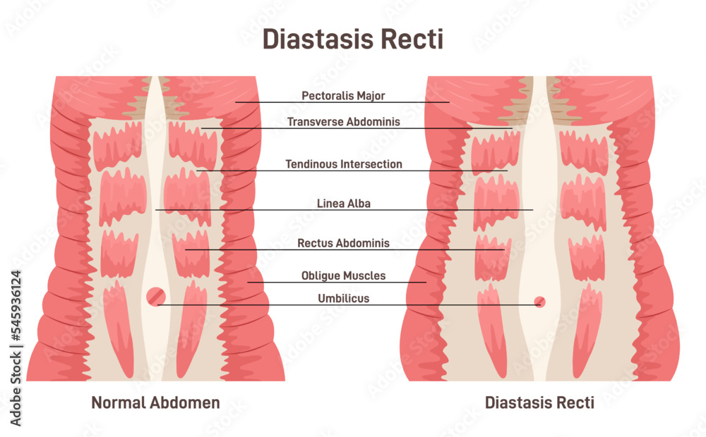 Diastasis rect. Abdominal muscles separation. Human torso muscles Stock Vector Adobe Stock