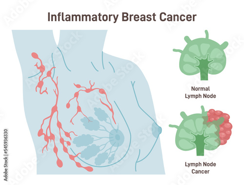 Inflammatory breast cancer. Detailed breast medical anatomy.