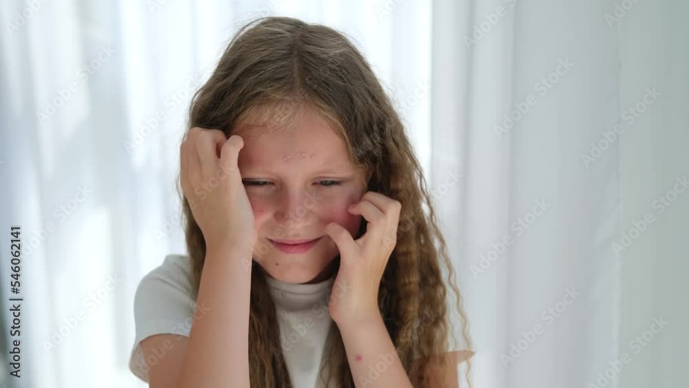 The child scratches his head with a rash. Itching from chickenpox in a girl. The child scratches his head with a rash. Itching from chickenpox in a girl.