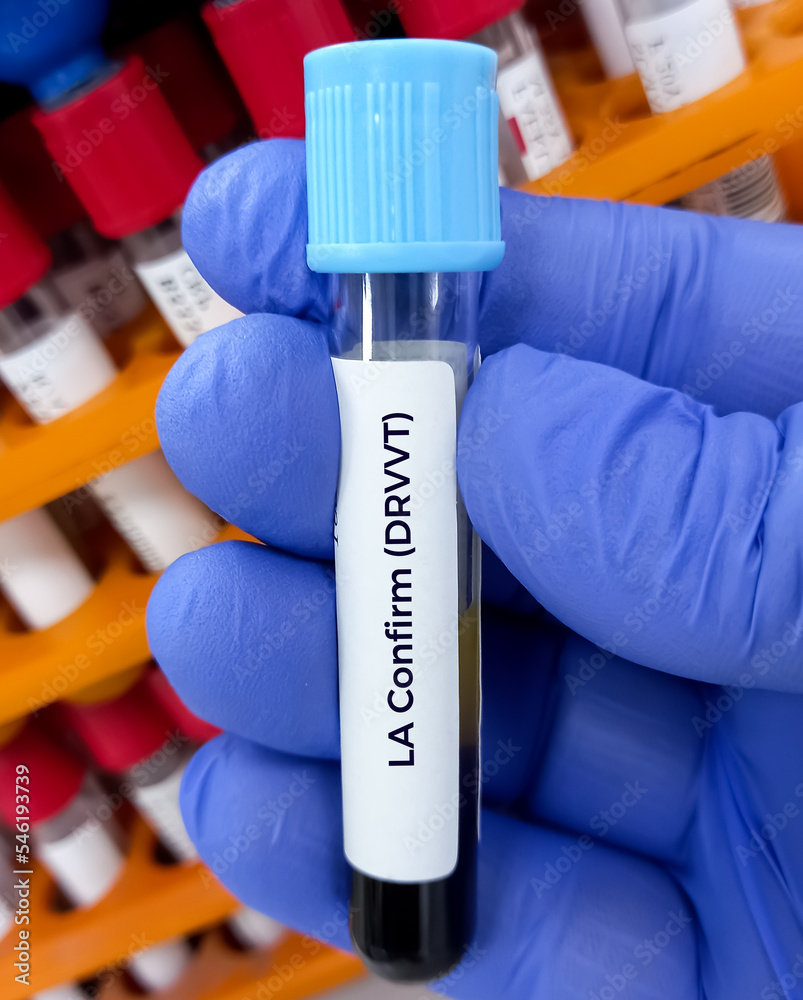 Scientist holding blood sample for LA(Lupus Anticoagulant) confirm test