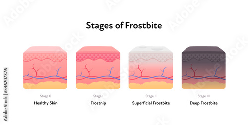 Frostbite anatomical infographic poster. Vector flat medical illustration. Stages of hypothermia disease. Skin layer stage of healthy, frostnip, superficial and deep. Design for healthcare dermatology
