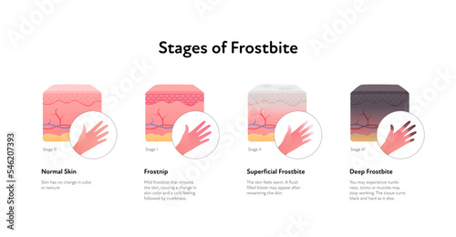 Frostbite anatomical infographic. Vector flat healthcare illustration. Stages of hypothermia. Skin layers and hand with finger healthy, frostnip, superficial and deep stage. Design for dermatology