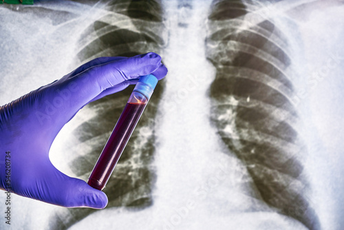 a hand in a blue medical glove holds a test tube with a blood sample against the background of an X-ray of the lungs