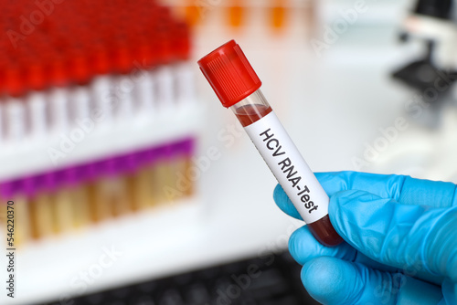 HCV RNA Test to look for abnormalities from blood photo
