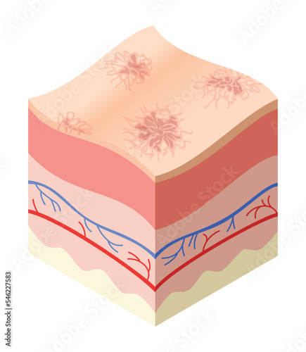 Skincare medical concept. Problems in cross-section of human skin horizontal layers structure. Anatomy illustrative model unhealthly layer of skin