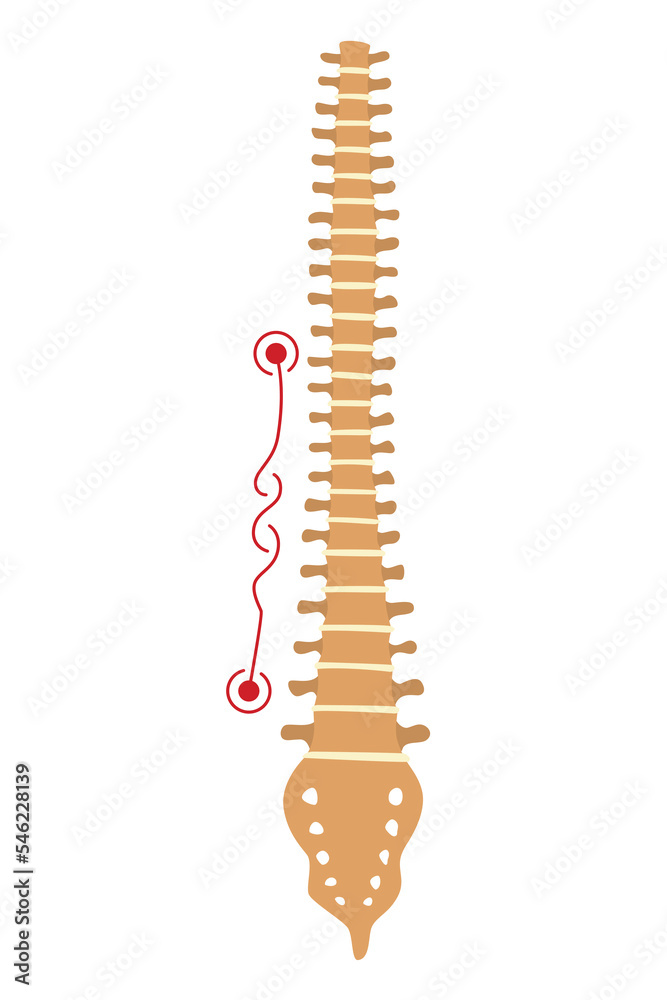 Spinal deformity. Symbol of spine curvatures or unhealthy backbones. Human spine anatomy, curved spine. Diagram with marked section. Body posture defect Spinal deformity. Symbol of spine curvatures or unhealthy backbones. Human spine anatomy, curved spine. Diagram with marked section. Body posture defect