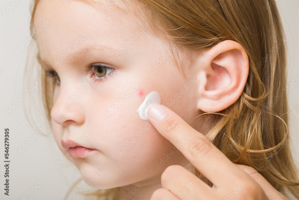 Young adult mother finger applying white moisturizing cream on toddler girl cheek. Red rash after bite of mosquito. Care about child body skin. Closeup. Side view. Young adult mother finger applying white moisturizing cream on toddler girl cheek. Red rash after bite of mosquito. Care about child body skin. Closeup. Side view.