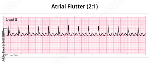 ECG Atrial Flutter (2:1)- 8 Second ECG Paper