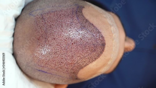 Detail of scalp of male lying down after hair transplant surgery 