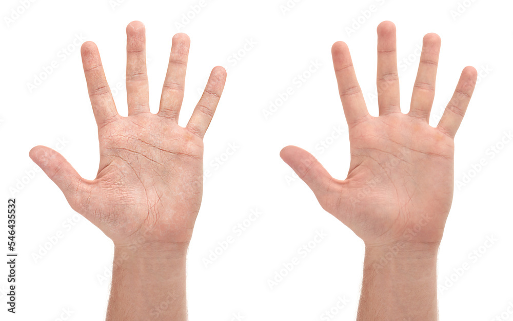 Collage with photos of man showing hands with dry and moisturized skin on white background, closeup Collage with photos of man showing hands with dry and moisturized skin on white background, closeup