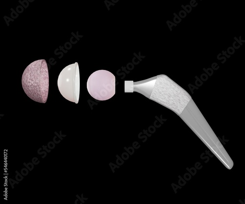 Total hip replacement components and examples of commercial hip stem implant 3D Rendering photo