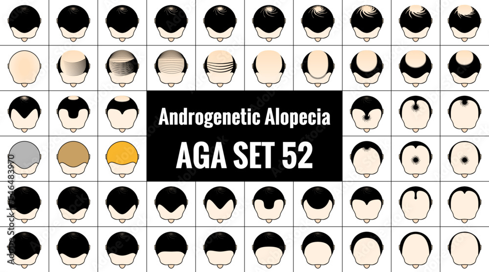 男性型脱毛症52種類。ハゲ頭のアイコン。AGA治療と薄毛の進行具合。ベクターイラスト。 Stock ベクター | Adobe Stock