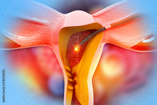 Medically accurate illustration of hysteroscopy of uterus. The appearance of the disease endometriosis. 3d illustration photo