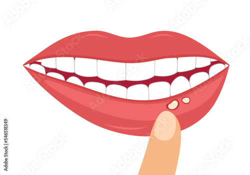 Mouth ulcer concept vector illustration on white background. photo