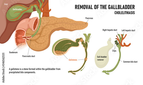 Cholecystitis. Inflammation of the gallbladder and bile ducts. Gallstones. Removal of the gallbladder photo