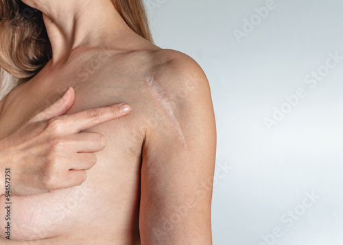 Woman have scar on shoulder over white background. Installation of a metal plate after fracture. Woman pointing finger at shoulder scar.