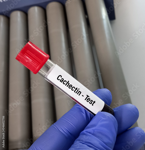 Blood sample for Cachectin test, an inflammatory cytokine produced by macrophages or monocytes during acute inflammation.TNF-α or Tumor necrosis factor alpha test. photo