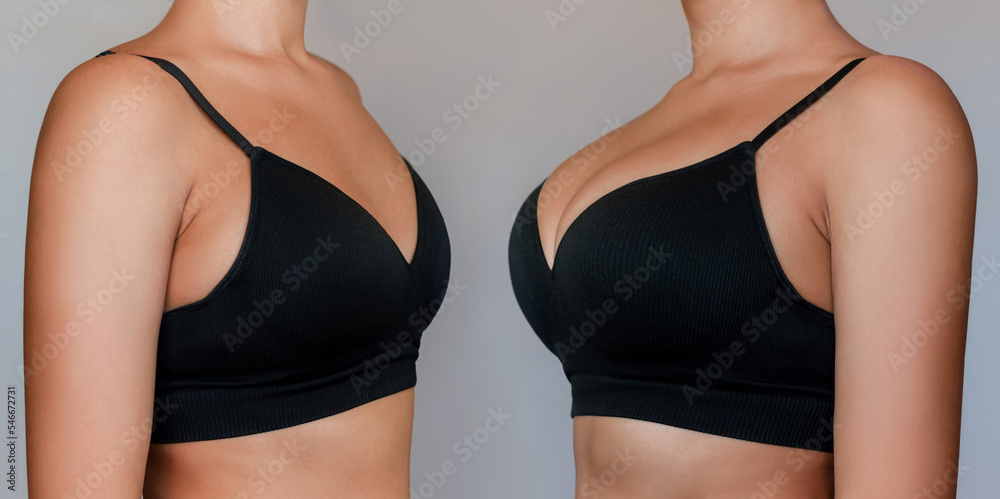 Young tanned woman in black bra before and after breast augmentation with  silicone implants. The result of a breast lift. Breast size correction  isolated on a gray background. Plastic surgery concept Stock