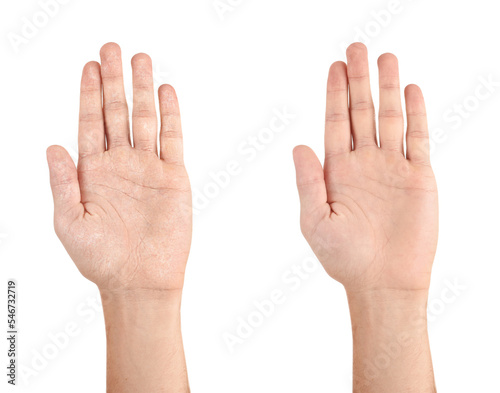 Collage with photos of man showing hands with dry and moisturized skin on white background, closeup