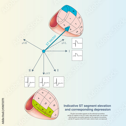 When acute transmural ischemia occurs in one side myocardium, the ST-segment of the ECG leads are elevated, while the contralateral myocardium can have corresponding ST-segment depression.