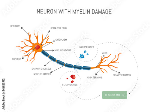 Infographic of a neuron damaged by lymphocyte and macrophage attack that destroys myelin in multiple sclerosis disease.