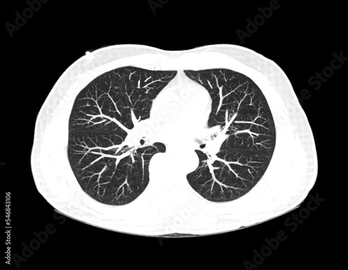 CT scan of Chest or lung  at radiology department in hospital. Covid-19 scan body xray test detection for covid virus epidemic spread concept